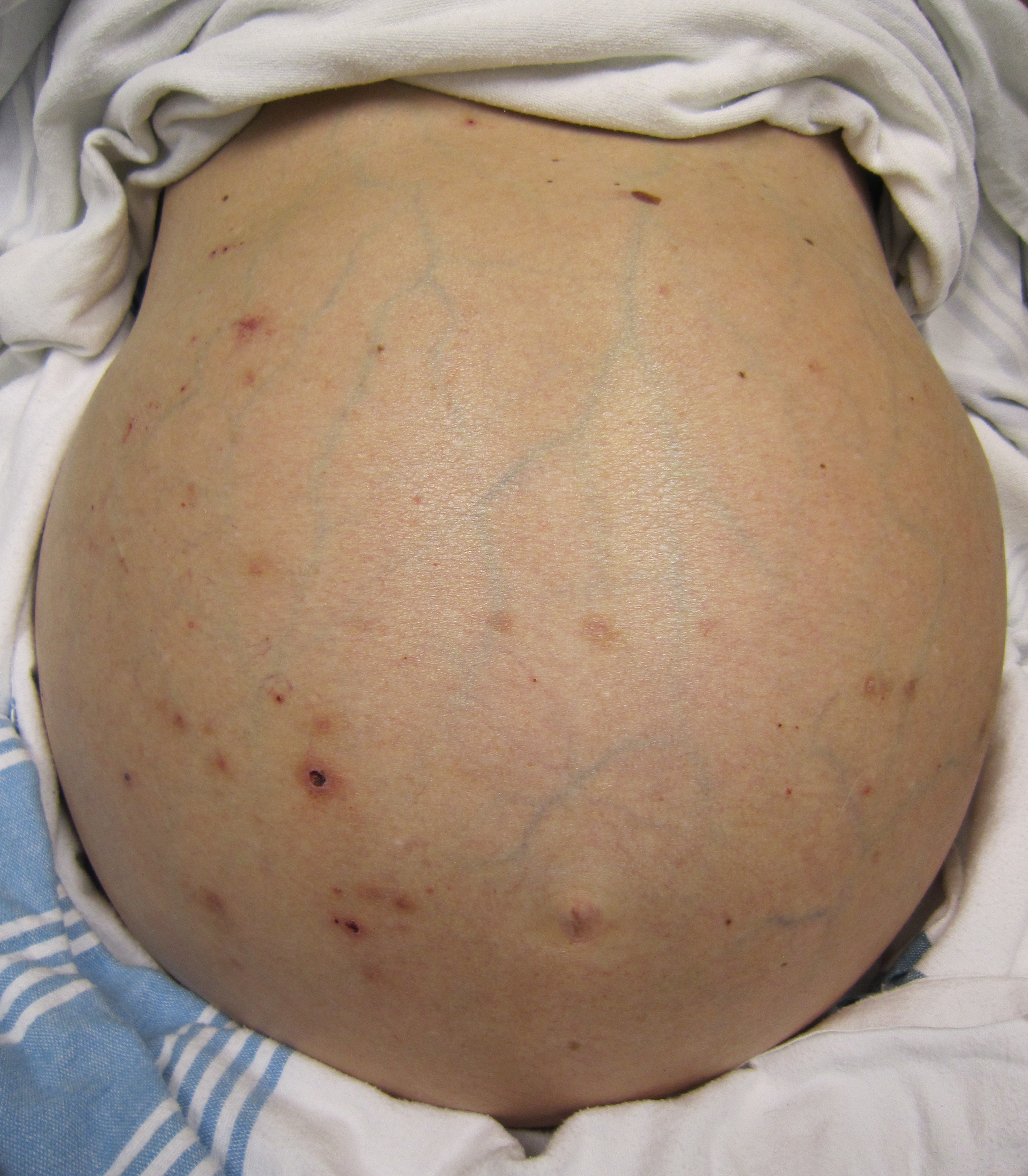 Clinical photograph of a man with a severely swollen abdomen caused by ascites from liver failure, with yellowing of the skin from jaundice