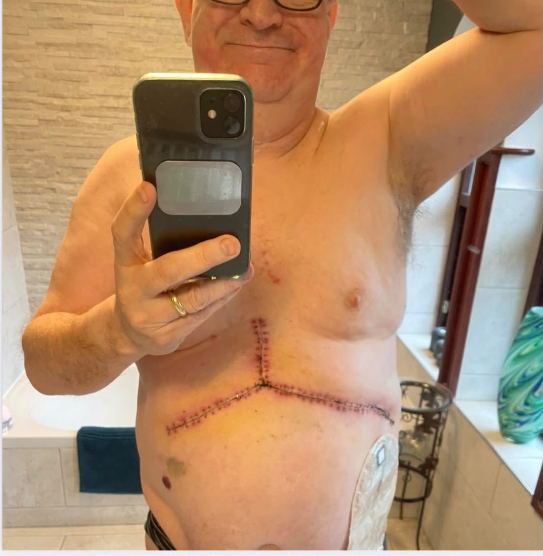 At home after Roux-en-Y surgery, scar healing well