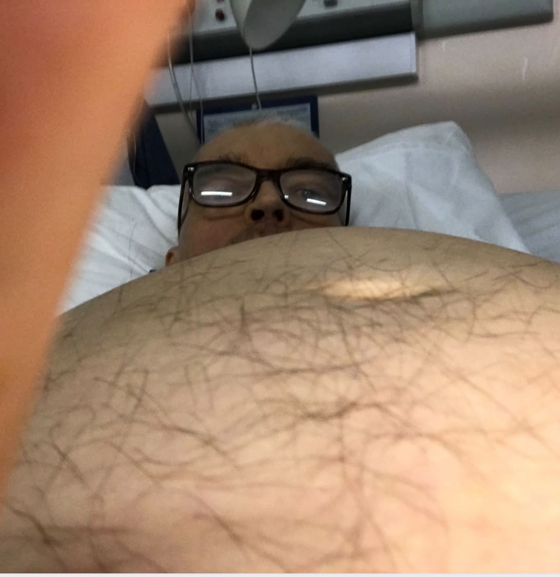 Brian in hospital with severe abdominal swelling caused by ascites