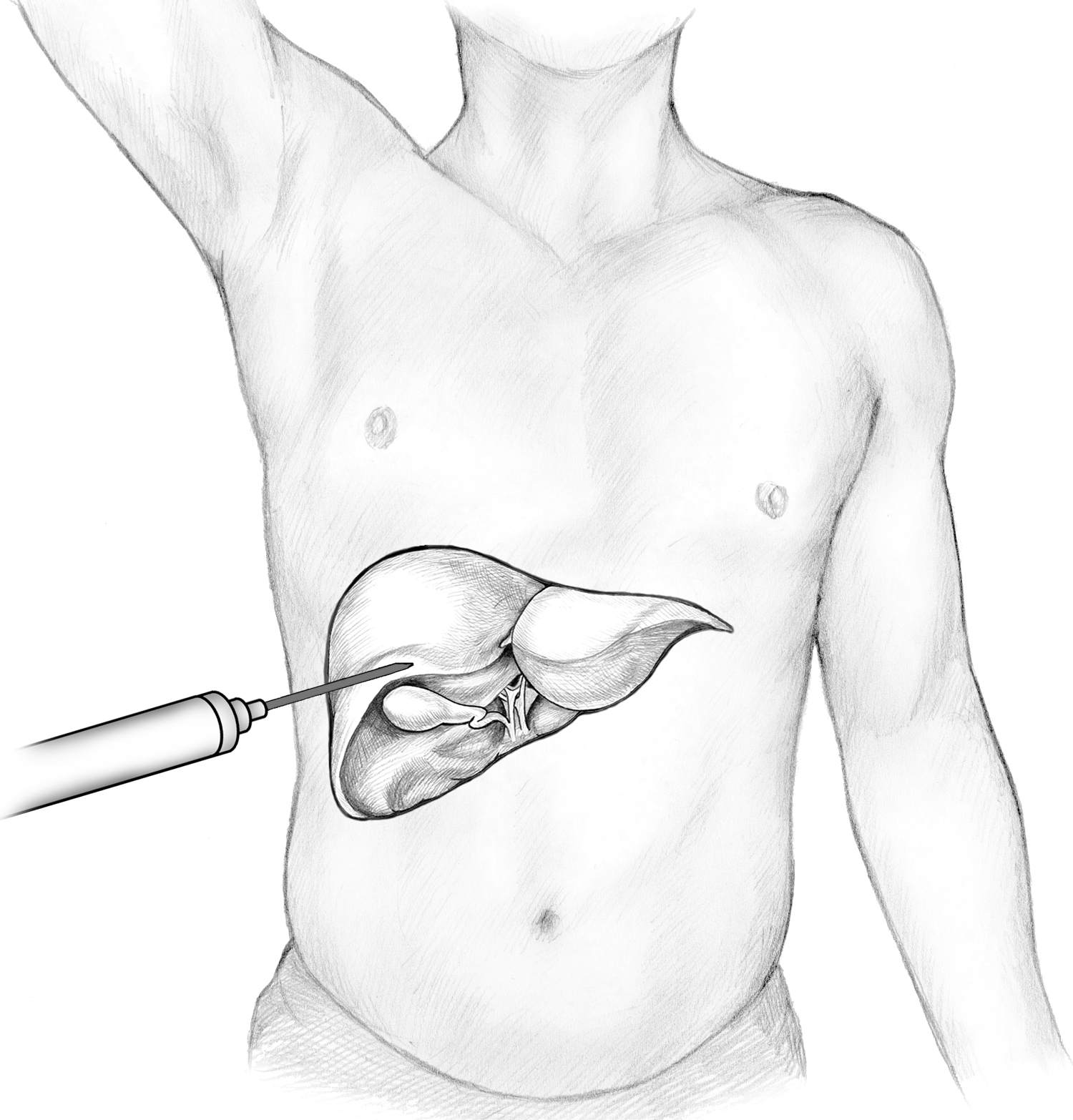 Illustration of a liver biopsy procedure, showing a needle inserted through the abdomen into the liver to take a tissue sample