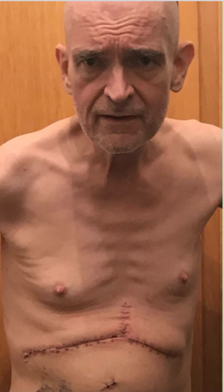 Brian showing the large Mercedes-shaped surgical scar across his abdomen after his liver transplant
