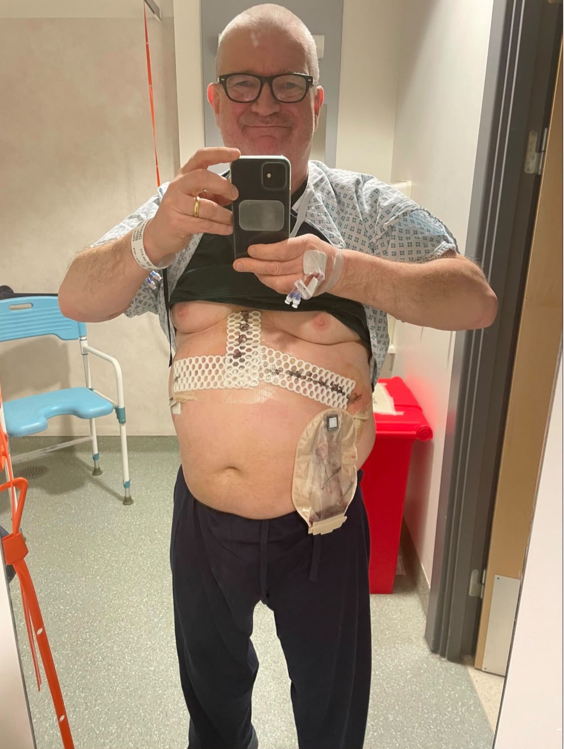 Recovering on the ward after Roux-en-Y surgery, with dressings and a drainage bag in place