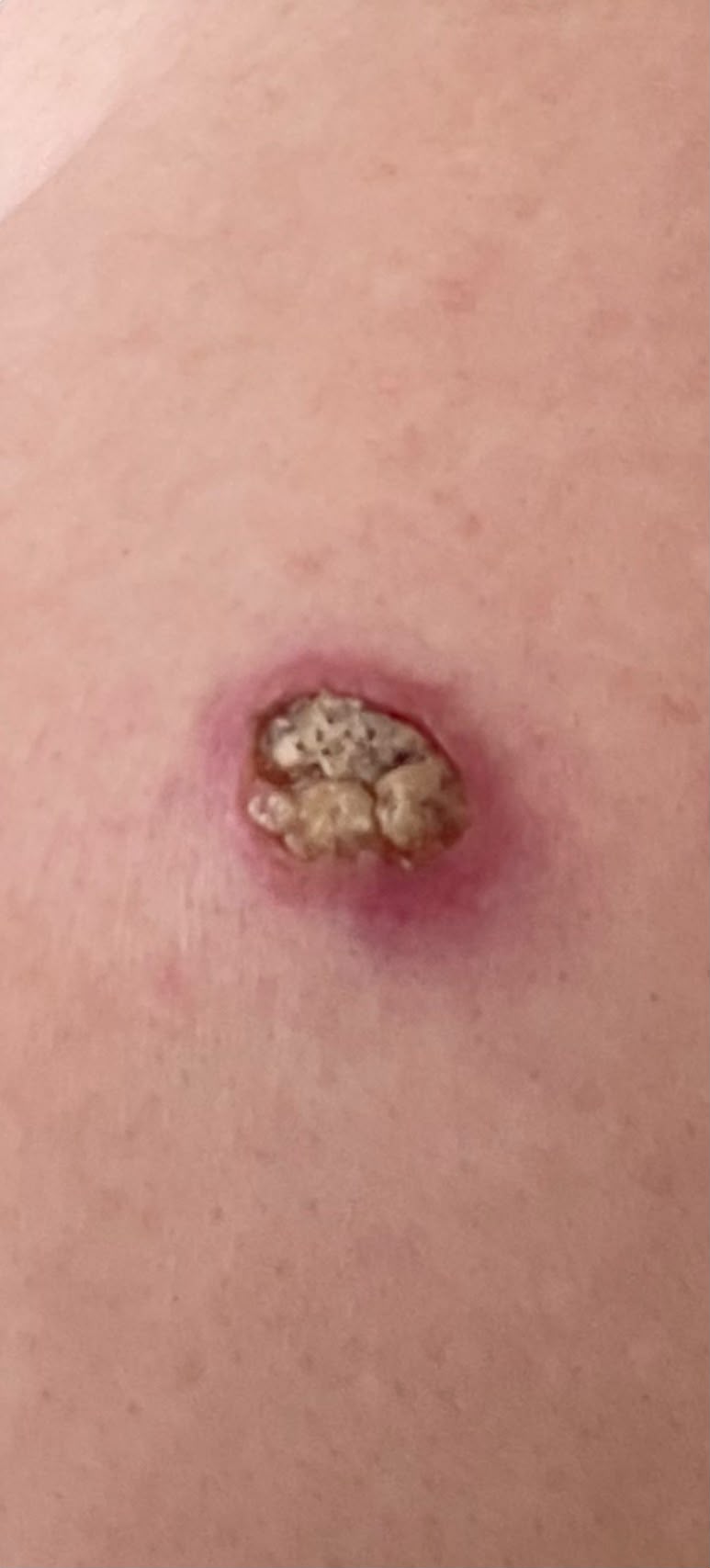 Close-up of a squamous cell carcinoma lesion on the skin