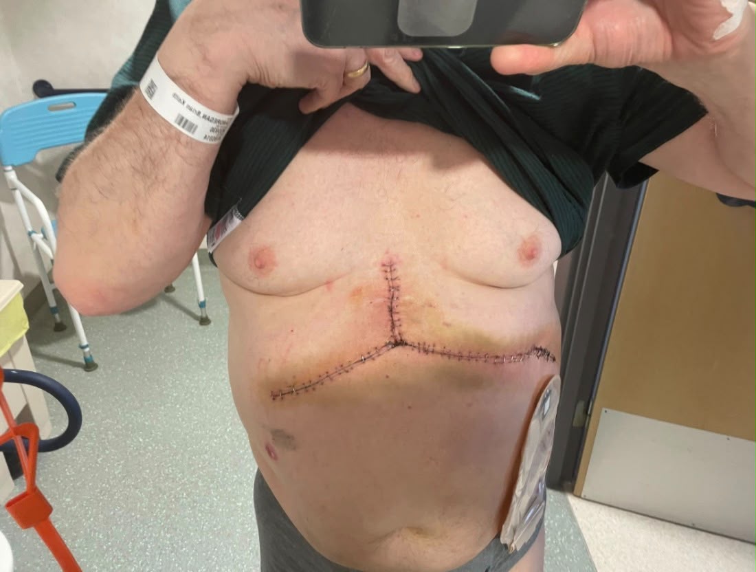 Healing Roux-en-Y surgical incision with clips still in place