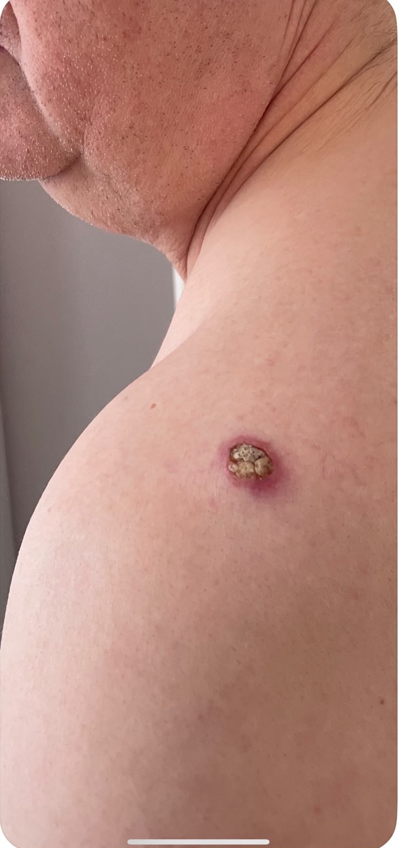 Squamous cell carcinoma lesion on the shoulder