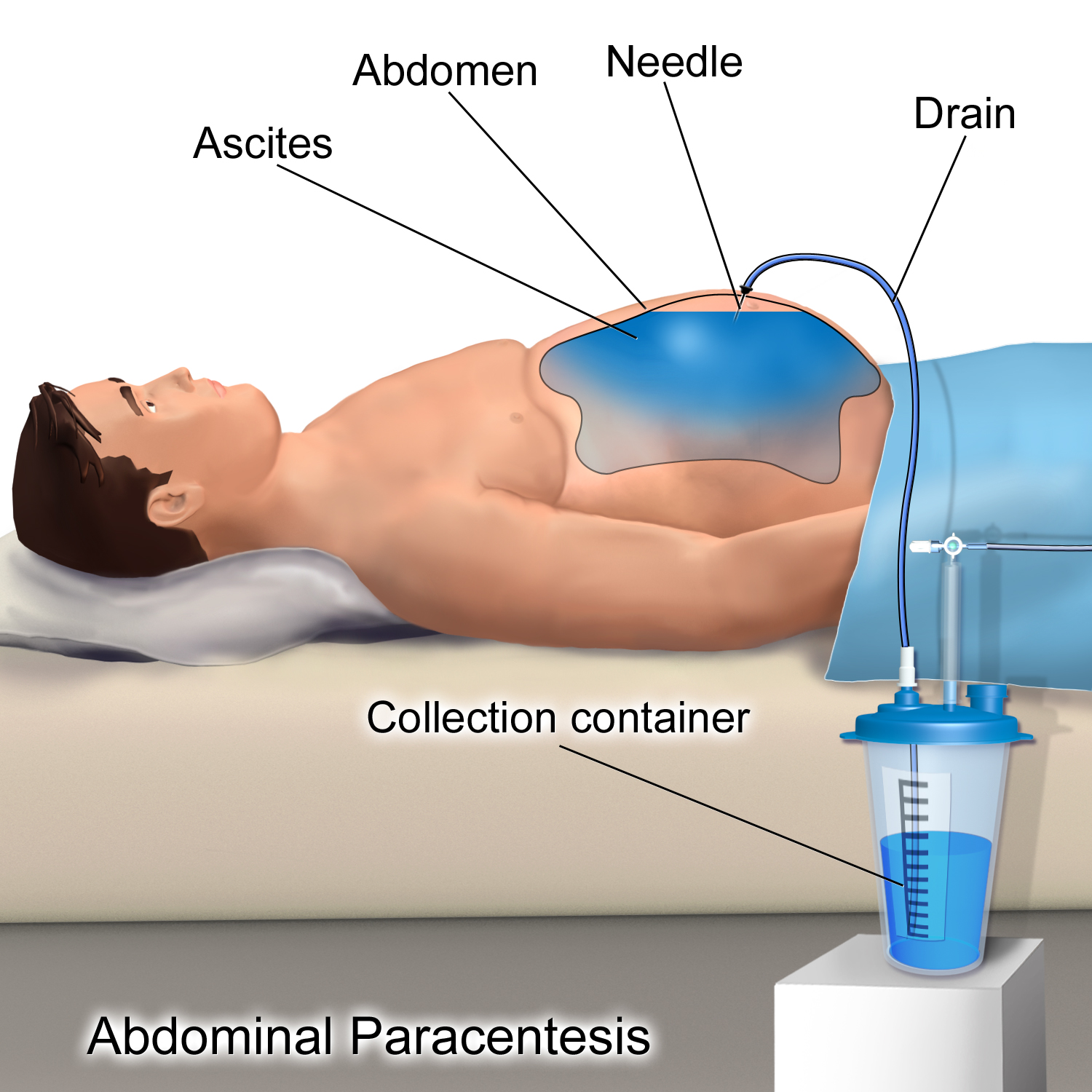 Medical illustration of abdominal paracentesis, showing a drain inserted through the abdominal wall to remove built-up fluid