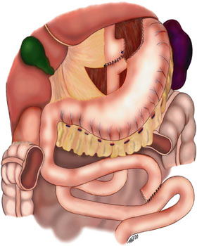 Schematic diagram of the Roux-en-Y anastomosis technique, showing the Y-shaped reconnection of the small bowel